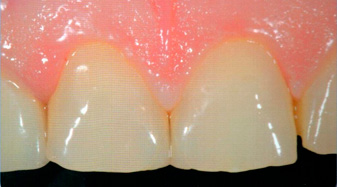 нанопокрытие зубов
