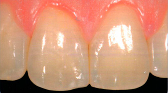 нанопокрытие зубов диастема после