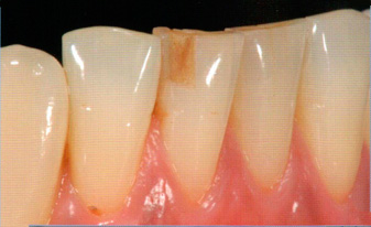 нанопокрытие зубов скол