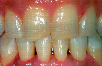 нанопокрытие зубов дефект
