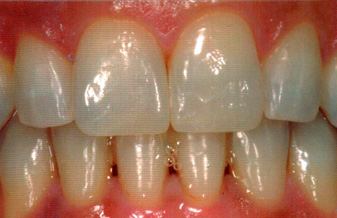 нанопокрытие зубов дефект после